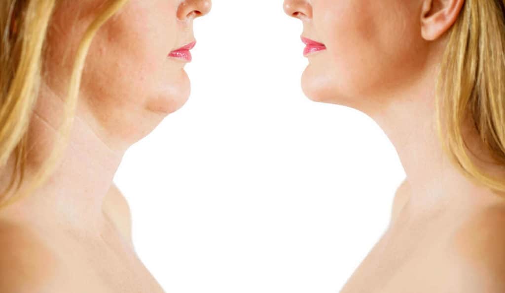 Double Chin treatment Ham before and after results