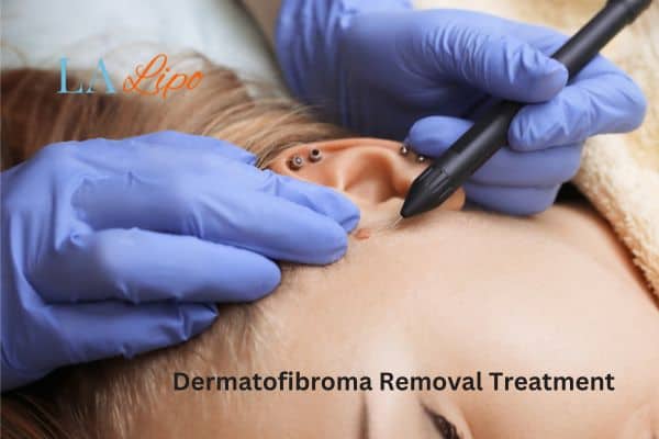Dermatofibroma Removal Treatment Ham