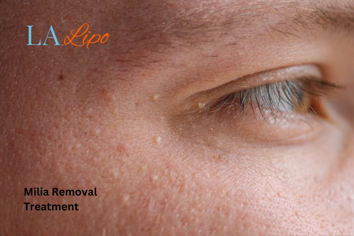Cryopen Milia Removal: Is It the Easiest and Safest Option Ham?