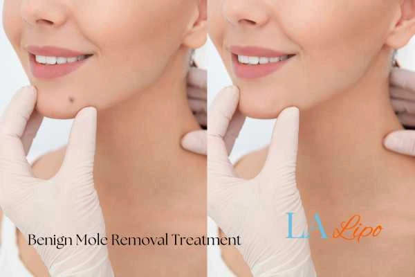 woman's before and after mole removal Ham results