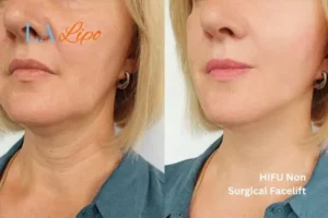 hi-fu for wrinkles Ham before and after results