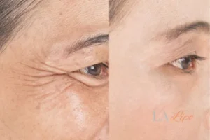 Before and after results of woman - HI-fu wrinkles reduction treatment Ham