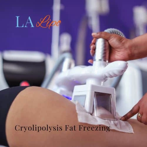 fat freezing - Cryolipolysis Ham