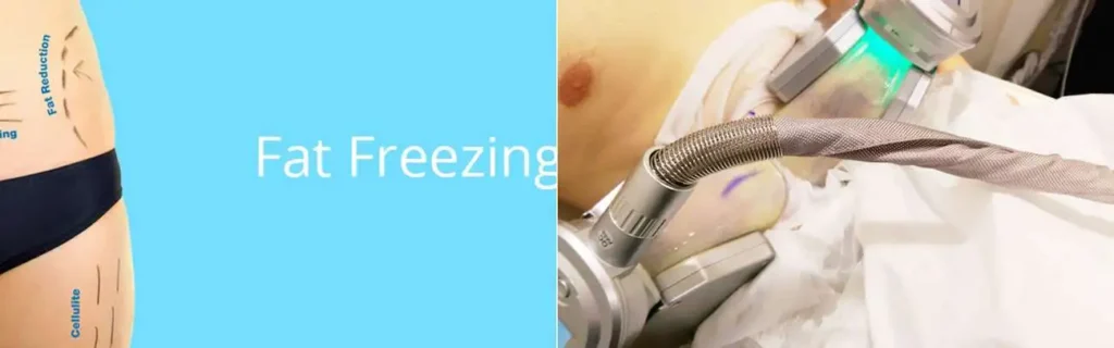 multi areas of a persons body having coolsculpting Ham treatment