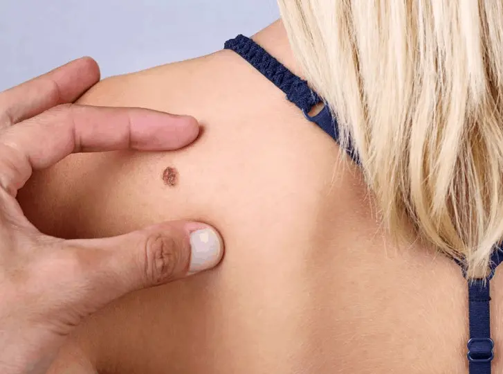 woman having mole removal Ham consultation before treatment.