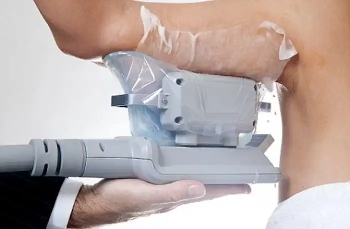 Picture of fat freezing Ham on the upper arms.