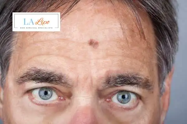 Solar Lentigo Removal Ham image of man with mark on his forehead