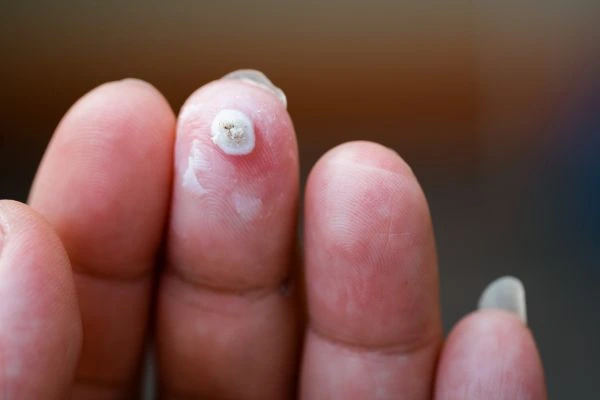 wart on person finger - cryotherapy to treat from LA LIPO Ham