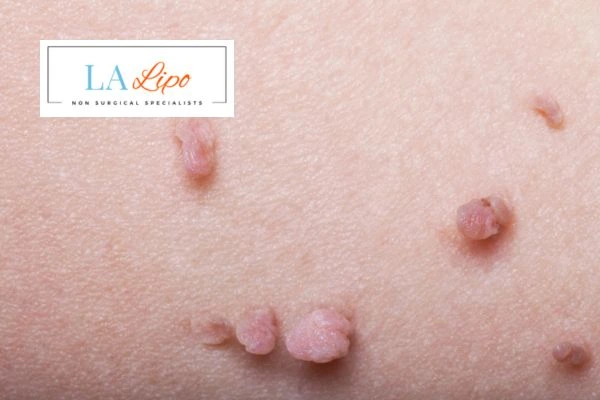 Does cryopen skin tag removal Ham hurt? Find out now call our team today!