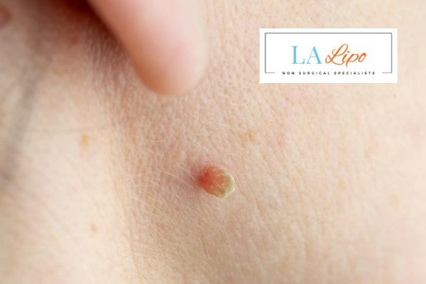 Book skin tag removal Ham today speak to our team now!