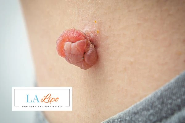 Interested in skin tag removal Ham? Concerned about the pain? Find out more today!