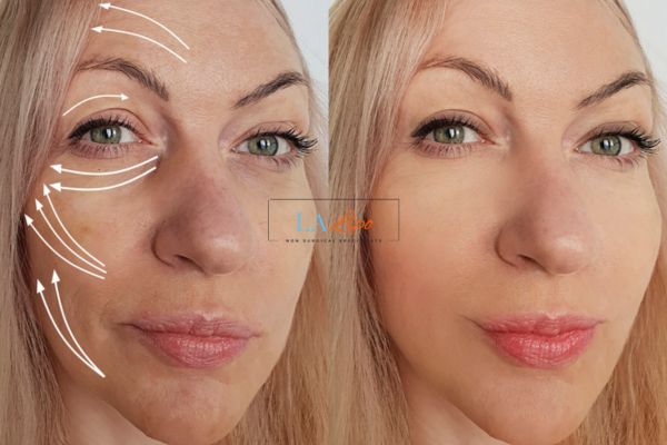 Morpheus 8 results Ham face lift.