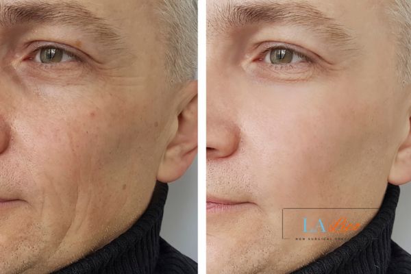 See the amazing results of Morpheus8 Treatment Ham!