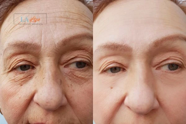 The powerful benefits of Morpheus8 Treatment Ham - Call Our team today!