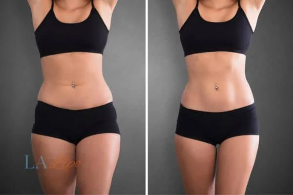 before and after results of non-surgical treatment to help a woman's body image and mental health Ham