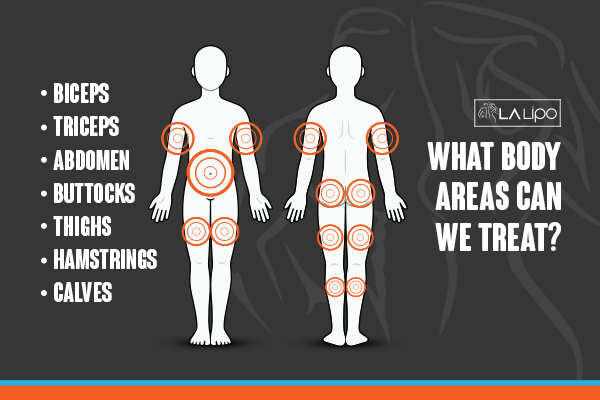 Diagram to show areas you can have LA-EMS Body Sculpting Treatment Ham
