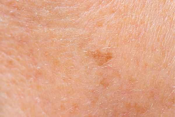 close up picture of age spots Ham