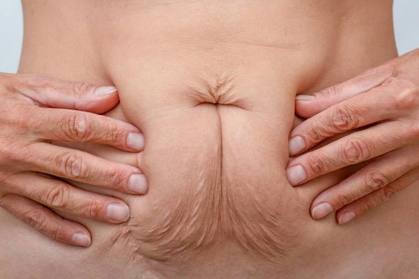 Image of a woman's stomach with loose skin - example of skin tightening Ham options