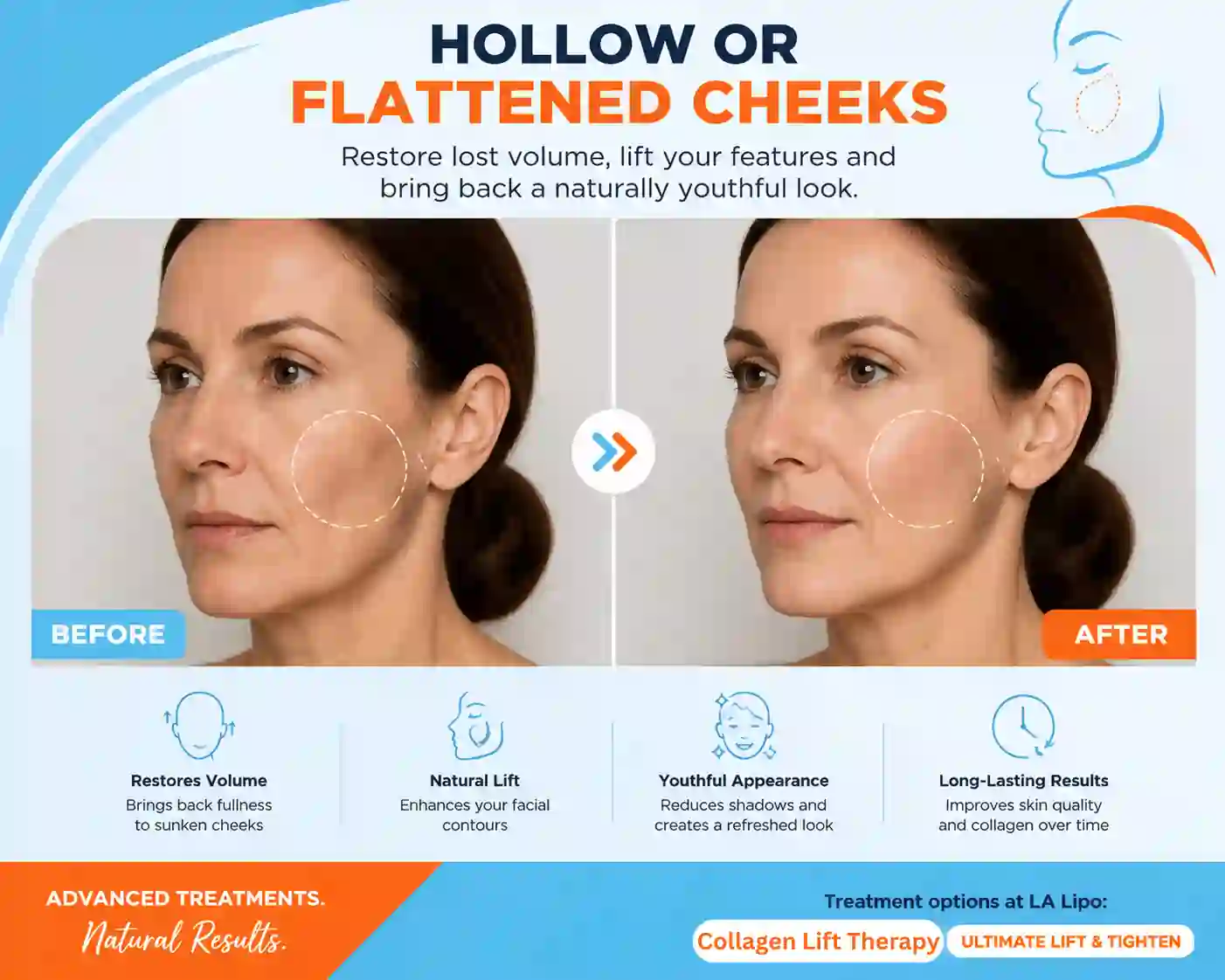 Sign #4: Hollow or Flattened Cheeks Ham