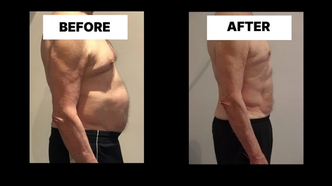 What Symptoms Can Diastasis Recti Cause in Men? Weak Core, Back Pain and Poor Posture Ham